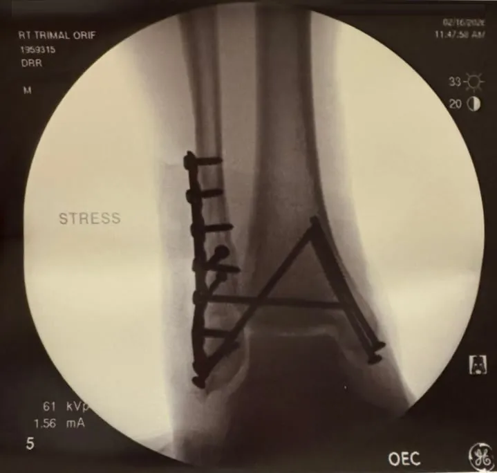 X-ray showing the plate and screws in my ankle