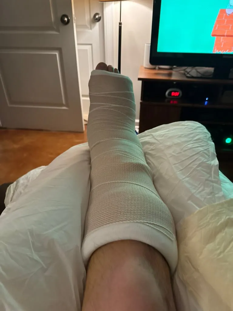 My leg wrapped in a splint following surgery, propped in my recliner